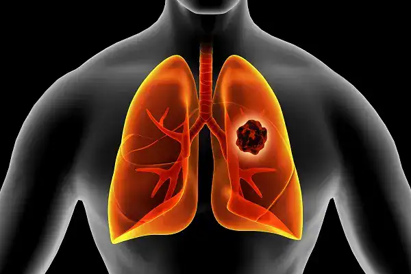 Graphic of lungs demonstrating age-related changes in lung tissue.